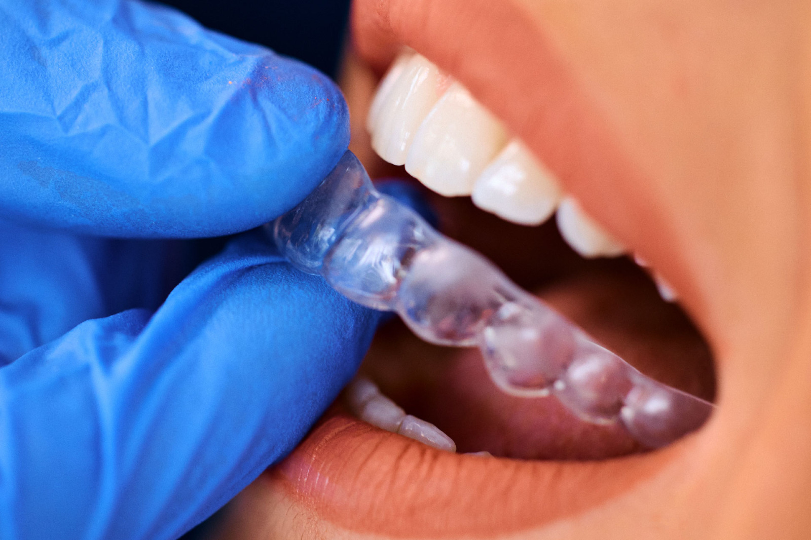 Invisalign in Hyderabad