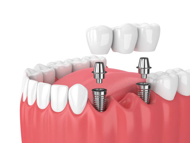 best dental implants hospital near me