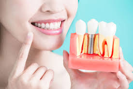 dental implants in Hyderabad